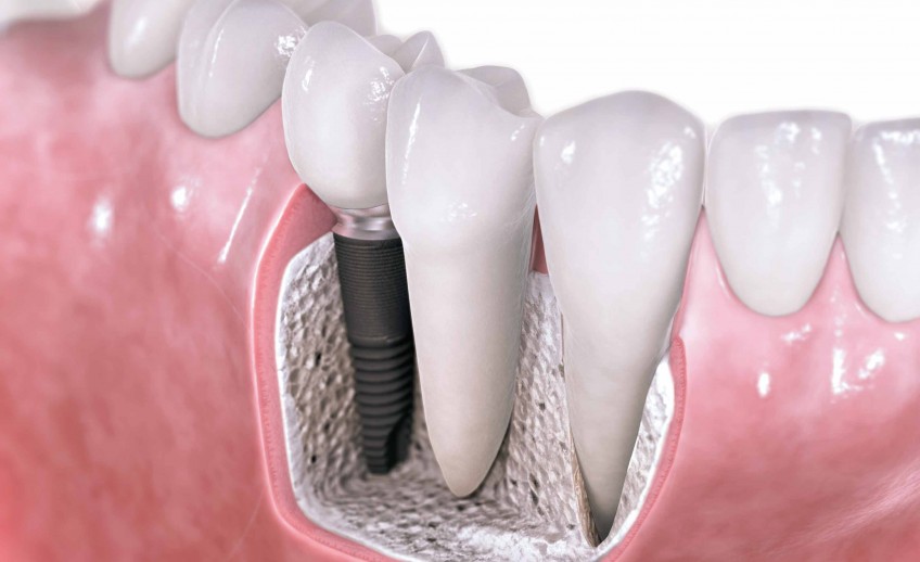 Implantología dental